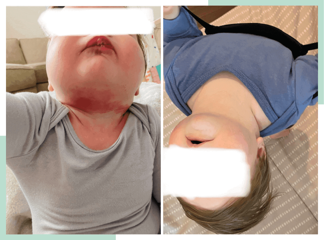 Side by side of a baby after eczema treatment