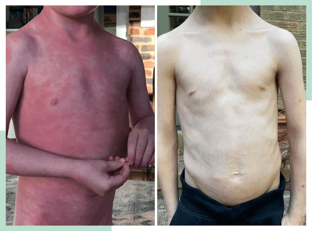 Eczema Before and After Treatment