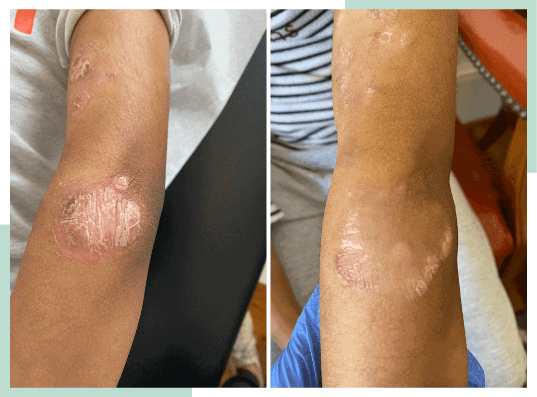 Before and After Eczema Treatment Program