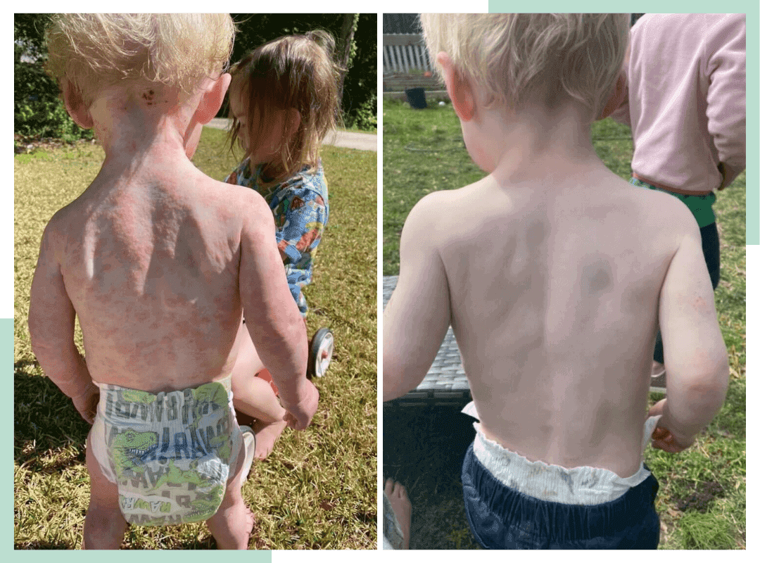 A side by side comparison of a baby before and after a successful eczema treatment.